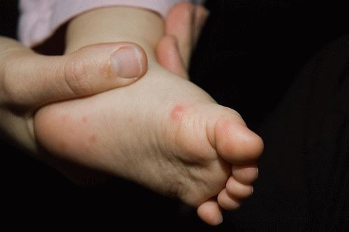 Синдром Рука Нога Рот Фото