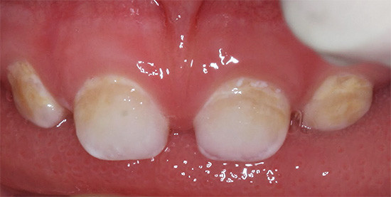Проблемы молочных зубов стоматология томск детская суворова